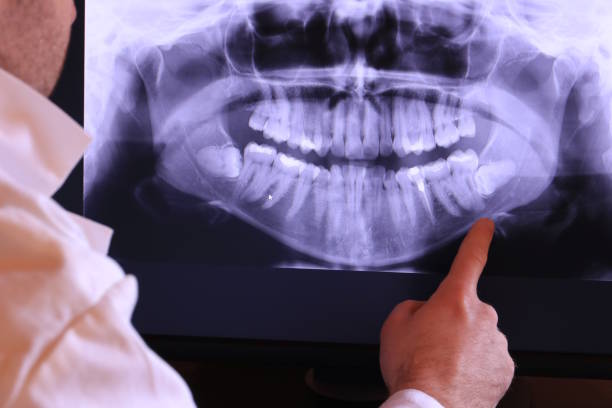 Best Emergency Wisdom Tooth Extraction in Ben Bolt, TX